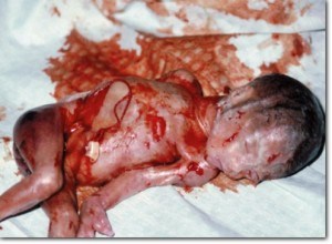 aborted-child
